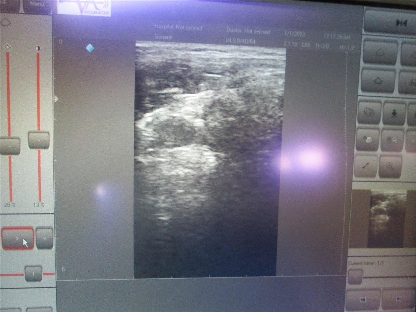 Used Escalon VU65000 VascuView Portable Ultrasound Vascular Ultra Sound Pulse Echo